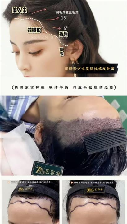 上海七星整形发际线植发
