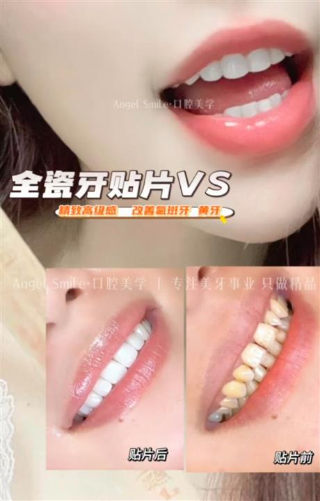 上海七星艺容术整形全瓷牙贴片美牙