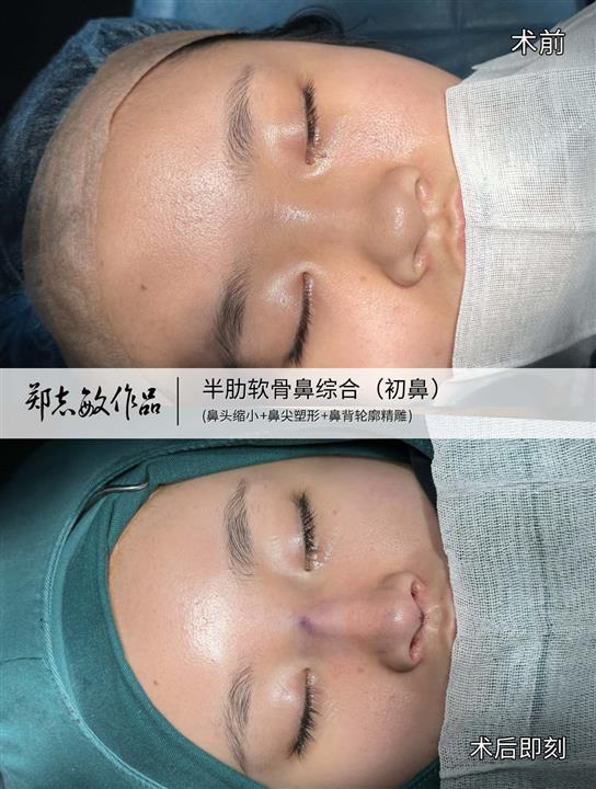 郑志敏医生半肋膨体妈生自然鼻型