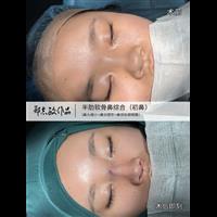 郑志敏医生半肋膨体妈生自然鼻型