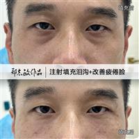 郑志敏医生注射填充泪沟改善疲倦脸