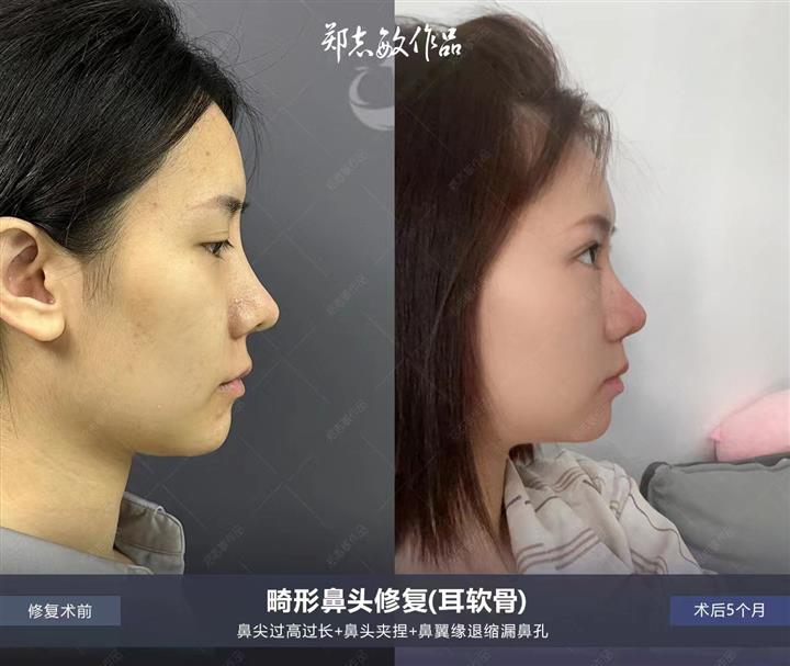 郑志敏隆鼻医生网红高鼻头尖鼻头修复改善案例