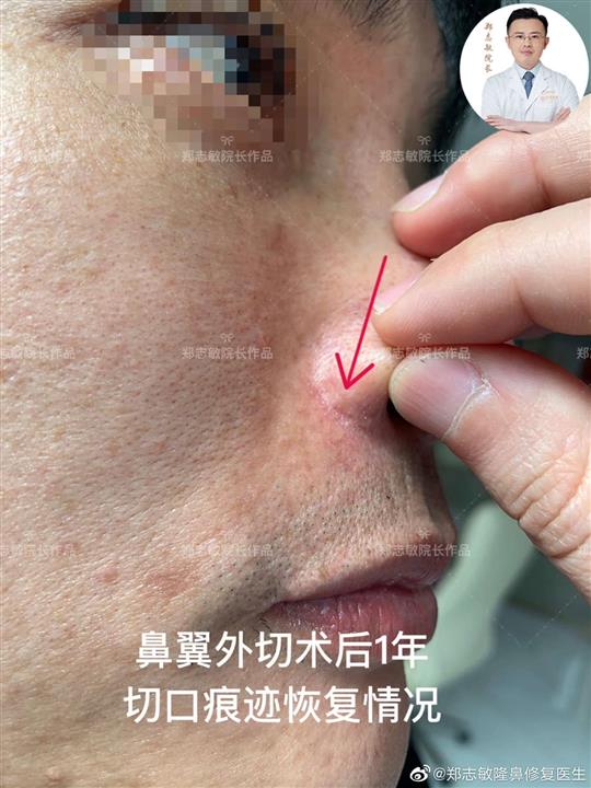 郑志敏鼻整形鼻翼外切手术后1年