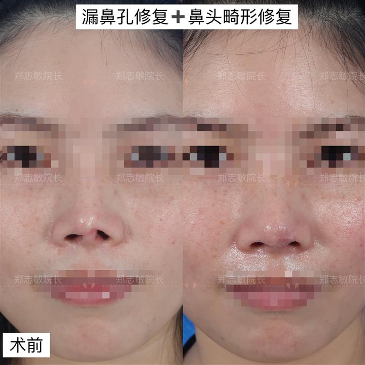 郑志敏院长露鼻孔修复和鼻头畸形修复案例
