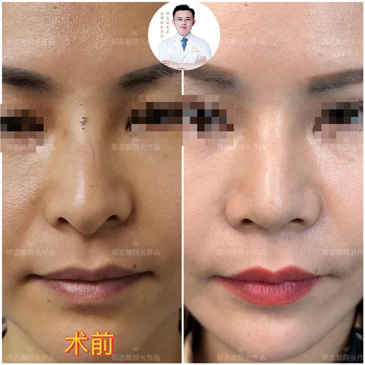 郑志敏医生鼻整形