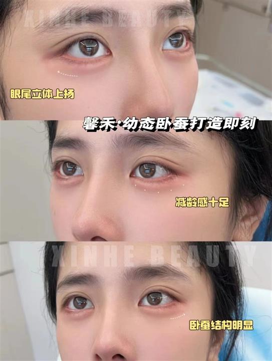 上海娜慕馨禾卧蚕注射