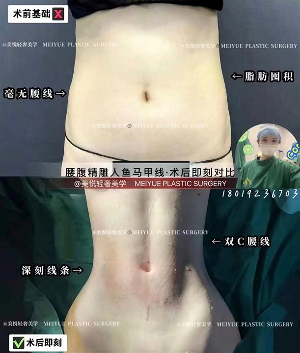 上海娜慕整形腰腹吸脂