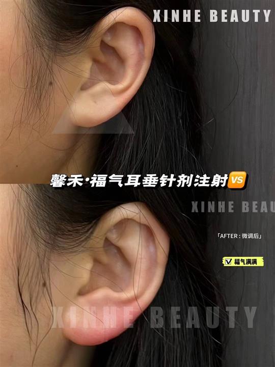 上海娜慕馨禾福气耳垂注射