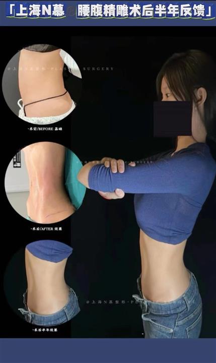 上海娜慕整形腰腹环吸