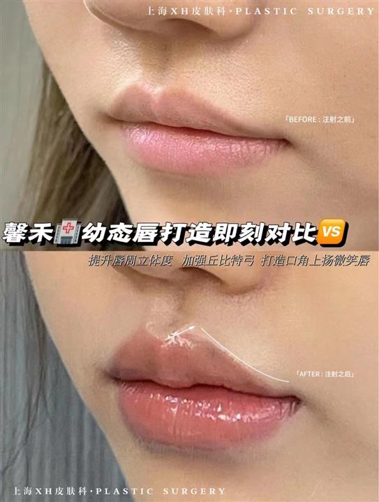 上海娜慕整形**唇