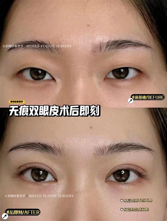 上海娜慕医美埋线双眼皮