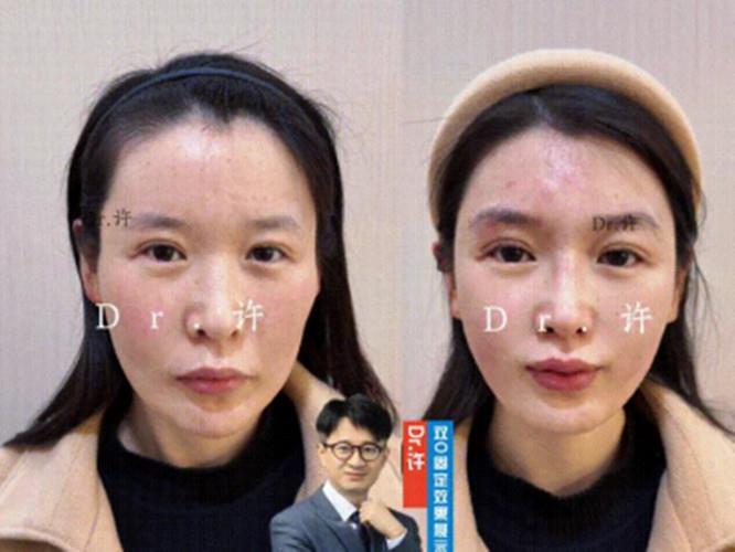 许旭亮面部提升医生